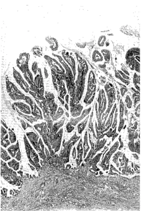 Fig.  8.  A  benign  locule  of  cystadenoma  showing  single  layer  of  columnar  epithelium  (Case  2,  H  &amp;  E