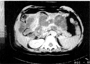 Fig.  1.  CT  scan  of  a  patient  with  multiple  pseudocysts  around  the  head  and  body  of  the  pancreas