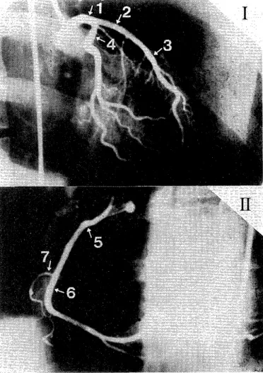 Fig.  1  :  The  sites  of  measurement  in  coronary  angiograms. 