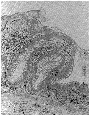Fig.  1  The  localisation  of  ECP  in  the  colonic  mucosa  of  UC. 
