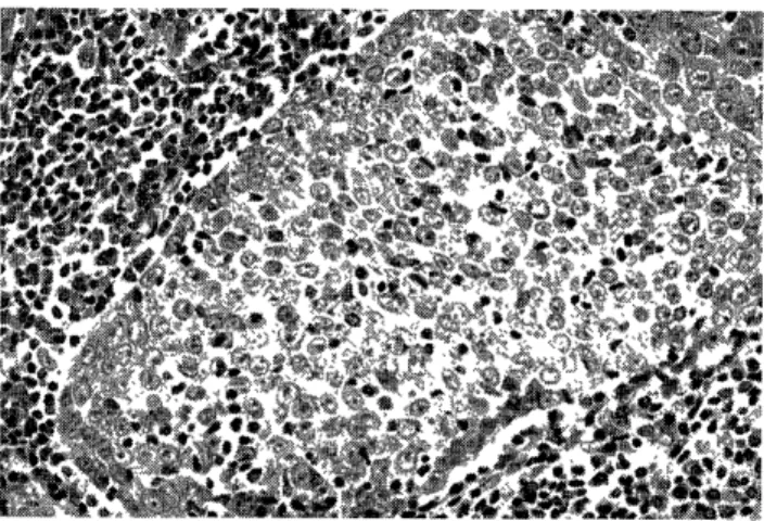 Fig.  7.  China  case:  Undifferentiated  carcinoma  (non-lympho- (non-lympho-epithelioma)  type  of  nasopharyngeal  carcinoma  with  numerous  lymphoid cell infiltrate