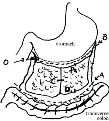 Fig. 1.  Mobilization  of the omentum 