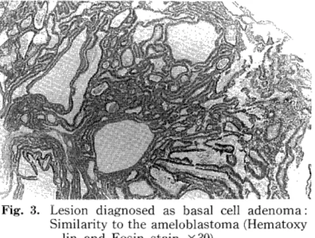 Fig.  1.  Islands  and  nest  of  tumor  epithelium  lying        below  the  surface  epithelium  (Hematoxylin 