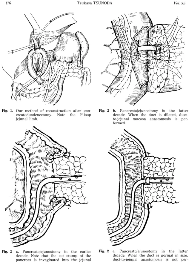 Fig.  1.  Our  method  of  reconstruction  after  pan-        creatoduodenectomy. Note the  P-loop 