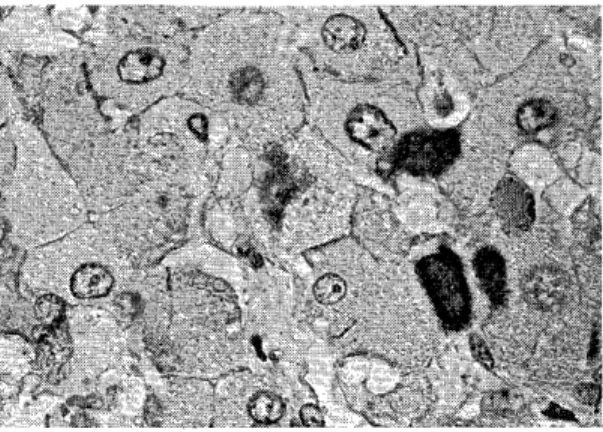 Fig.  3.  Membrane  type  and  inclusion  type  of         hepatitis B  surface antigen are  seen  in 