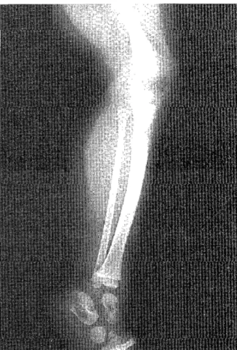 Fig.  3.  Cut surface  of this  tumor  is firm  or  rub-        bery in consistency, and  pale gray  to 