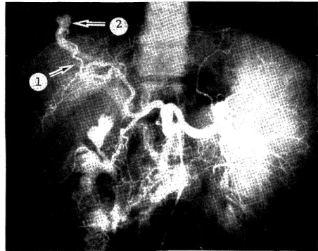 Fig.  2.  Preoperative  celiac  angiography  in  the  early  arterial  phase  showing  the         slightly  enlarged  anterior  superior  segmental  blanch  of  the  right  hepatic 