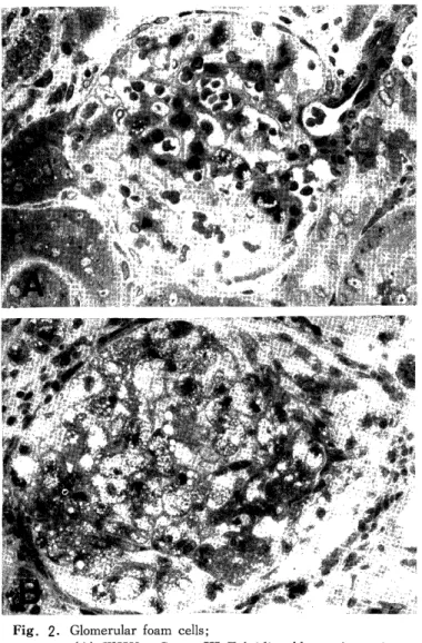 Fig.  2.  Glomerular  foam  cells; 