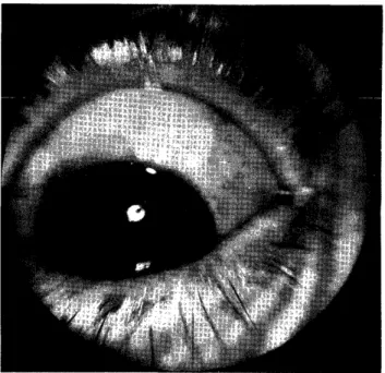 A Fornix-Based Conjunctival Flap by Limbal Incision for Trabeculectomy