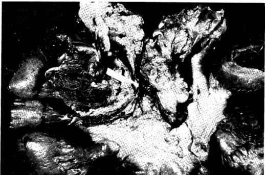 Fig.  3  Diffuse  infarction  of  the  small  intestine  due  to  venous  thrombus        (arrow)  of  SMA  (case  4)