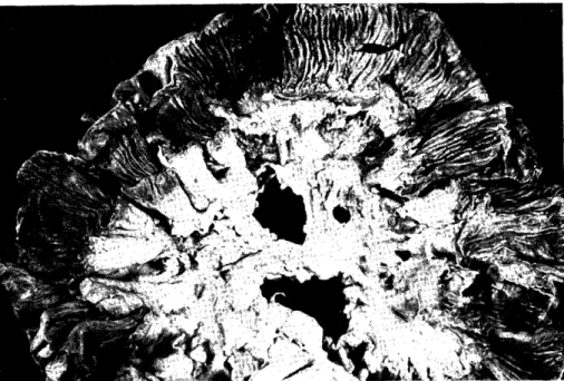 Fig.  5  Diffuse  non-occlusive  infarction  of  the  small  intestine  (case  6).