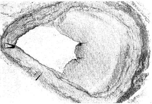 Fig.  11  Marked  atherosclerotic  narrowing  of  the  proximal  portion  of  SMA        in  diffuse  non-occlusive infarction (case  10)  (EVG  stain,  x20).