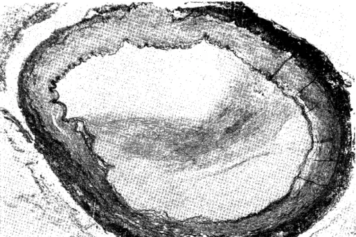 Fig.  12  Mesenteric  arteries  of  case  12. 