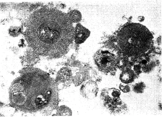Fig.  9  Electron  micrograph  of  bronchoalveolar  lavage  fluid  (13,000x).  The  electron-         opaque  bodies  and  the  myelin-like materials  surrounding  them  are  observed.