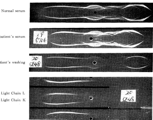 Fig.  12  Immunoelectrophoresis  revealed  the  major  proteins  of  serum  such         as  prealbumin, albumin, al-antitrypsin, transferrin and  IgG.