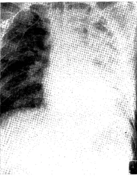 Fig.  4  Chest  roentgenogram  of  25th  May,  1982,        after three lavages, shows dramatic  