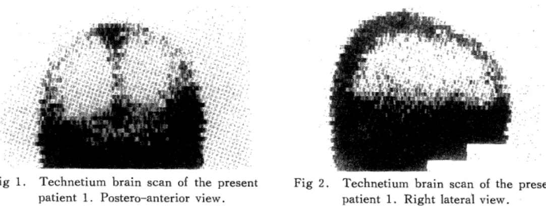 Fig  1.  Technetium  brain  scan  of  the  present          patient 1.  Postero-anterior view.