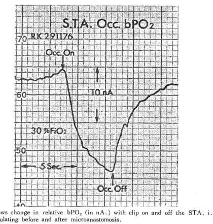 Fig.  1  Shows  change  in  relative  bPO2  (in  nA.)  with  clip  on  and  off  the  STA,  i