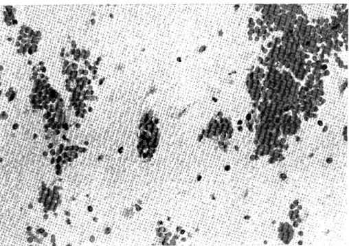 Fig.  2  .  Typical  ischemic  neurons  (center)  scattered  focal  hemorrhages  with           few  scattered  reactive  microglia.