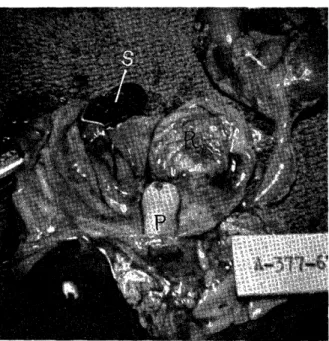 Fig.  2.  Photograph  shows:  P,  invaginated  penis  into          the urinary bladder; R, rectum; S, sigmoid 