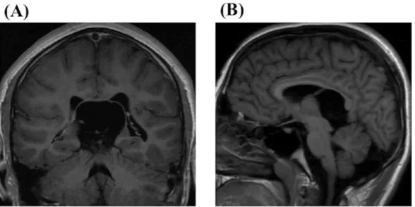 Figure 6. A 13-year-old boy associated with diplopia presented with a large quadrigeminal cistern  arachnoid cyst on MRI (A; coronal section and B; sagittal section on T1WI)