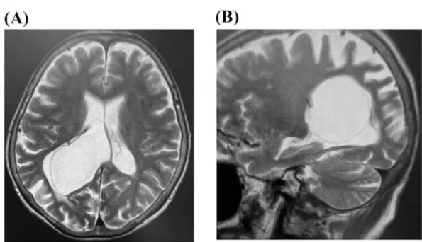 Figure 7. A 54-year-old female associated with headache and mild burred vision on her left showed  a large arachnoid cyst in the right lateral ventricle on MRI (A; coronal section and B; sagittal  section on T2WI)