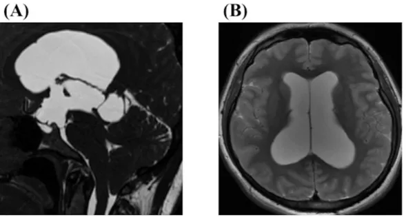 Figure 8. A 28-year-old female complained of chronic and progressively worsening headache after  delivery of her first child