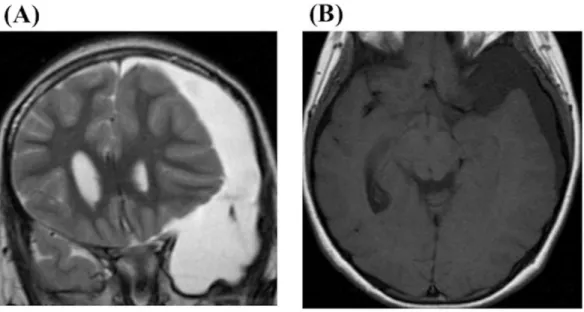Figure 9. A 9-year-old girl suffered with a headache, nausea, and diplopia showed an arachnoid cyst in  the left-side middle fossa and ipsilateral CSDH with a remarkable mass effect on MRI (A; coronal  section on T2WI, B; axial section on T1WI)