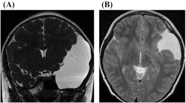 Figure 1. A 9-year-old boy complained of headache presented with a huge arachnoid cyst located in  the middle cranial fossa