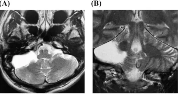Figure 2. A 35-year-old male suffered from mild headache presented with arachnoid cyst at the  cerebellopontine angle on MRI (A; axial section and B; coronal section on T2WI)