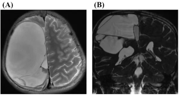 Figure 3. An 11-year-old boy manifested mild hemiparesis presented with interhemispheric  arachnoid cyst with multiple cystic components on MRI (A; axial section on T2 WI and B; coronal  section on FIESTA)