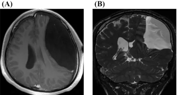 Figure 4. A 22-year-old male complained of headache and unsteadiness presented with a huge  convexity arachnoid cyst at the parietal region