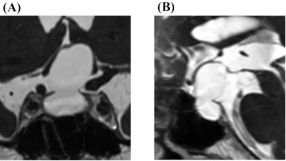 Figure 5. A 62-year-old female manifested with visual function impairment showed a large intrasellar  arachnoid cyst extending into the suprasellar cistern