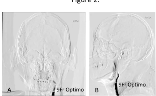 Figure 1：症例① ,  入院時 Magnetic Resonance  Imaging, A: diffusion weighted image, 高信号域は 認めなかった。B: Magnetic Resonance Angiography,  左内頚動脈の描出を認めなかった。 Figure 2：症例① ,  脳血管撮影 , A:  左総頚動脈撮影 前後像 , B: 左総頚動脈撮影 側面像 , 左総頚動脈分岐部手前で閉塞していた。Figure 3.9Fr Optimomarksman閉塞部9Fr O