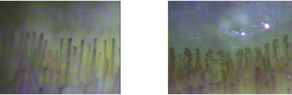 Figure 1: Example of images of capillaries, (Left) a normal state, (Right) an abnormal state, the capillaries are bent and the flow seems to be not smooth