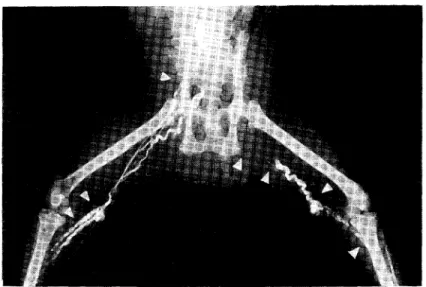 Fig. 12 Lymphogram after DEC administration showing enlarged popliteal lymphnode, dilatated afferent lymphatics and show flow of the contrast medium in a tortuous efferent lymphatics