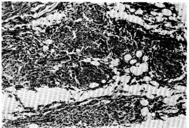 Fig. 4. Several epitheloid cell tubercles in subcutaneous tissue in ulcer base. Tuberculosis and sarcoidosis must be differentiated.