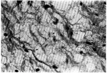 Fig. 8. Degeneative change in the individual fat tissue in non-ulcerated areas. Ghost out line of fat cells was seen