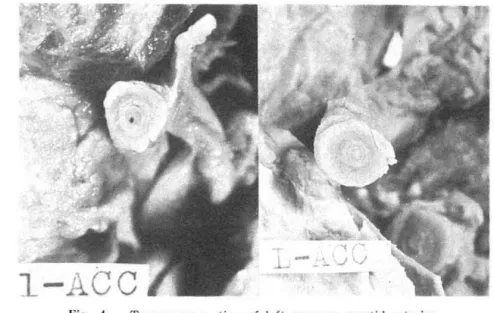 Fig.  6.  Typical  arterial  lesion  showing  the  obstructiGn  of  lume n  (t he  left  com mon  carotid  a rter y  of  Case  2) 