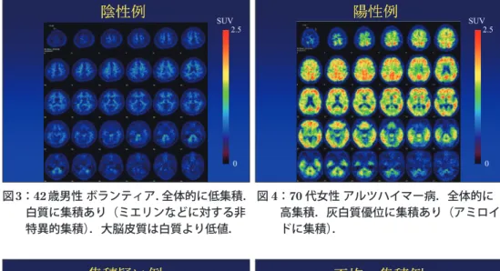 図 5 ： 70 代男性 レビー小体病．白質への集積 と同等かわずかに上回る集積を認める．集積疑い例集積疑い例   0 SUV  2.5  不均一集積例不均一集積例    0 SUV  2.5 図6：70代男性アルツハイマー病．左半球優 位に集積を認める．本症例以外に，後部帯 状回に限局性集積を認めた例，前頭葉に強 い集積を認めた例などを経験した． 図 7 ： 50 代男性 脳血管性認知症．全体的に低 集積．頭皮・静脈洞・鼻腔などの描出を認 める． 代謝亢進疑い例代謝亢進疑い例    0 SUV  2.5 