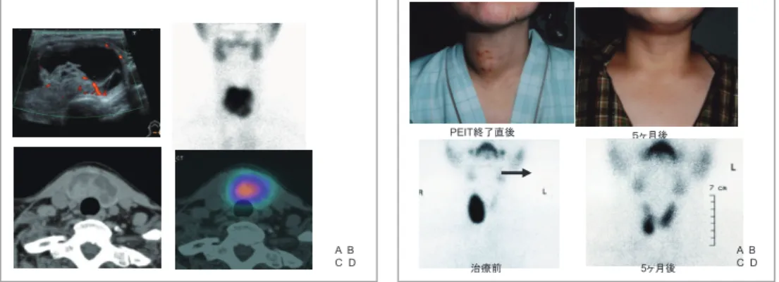 表 2. PET incidetaloma  の SUV 値 悪性腫瘍 / 精査された 悪性腫瘍 SUVmax* 良性腫瘍 SUVmax 悪性腫瘍と良性腫瘍 報告者 症例数（悪性腫瘍の頻度） （範囲） （範囲） の SUVmax の有意差 Cho IY, et al 17/44 （ 34.0% ） 10.7 ± 7.8 （ 2.2-32.9 ） 6.7 ± 5.5 （ 2.3-33.1 ） あり Bae HC, et al 23/99 （ 23.2% ） 6.64 ± 1.12 3.35 ± 1.69  あ