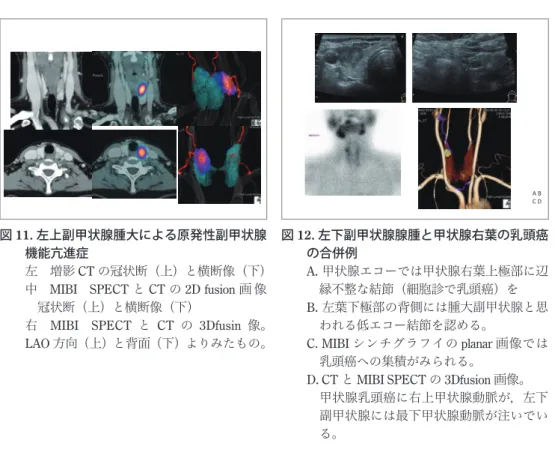 図 11. 左上副甲状腺腫大による原発性副甲状腺 機能亢進症 左　増影 CT の冠状断（上）と横断像（下） 中　MIBI　SPECT と CT の 2D fusion 画 像 　冠状断（上）と横断像（下） 右　MIBI　SPECT と CT の 3Dfusin 像。 LAO 方向（上）と背面（下）よりみたもの。 図 12