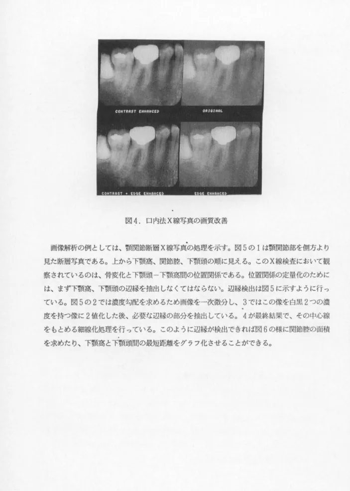 図 4 . 口内法 X 線写真の画質改善 画像解析の例と し ては、顎関節断層 X線写真の処理を示す。図 5 の l は顎関節部を側方より 見た断層写真である。上から下顎寓、関節腔、下顎頭の順に見える。この X 線検査において観 察されているのは、骨変化と下顎頭一下顎高間の位置関係である。位置関係の定量化のために は、まず下顎高、下顎頭の辺縁を抽出しなくてはならない。辺縁検出は図 5 に示すように行っ ている。図 5 の 2 では濃度勾配を求めるため画像を一次微分し、 3 ではこの像を白黒 2 つの濃 度を