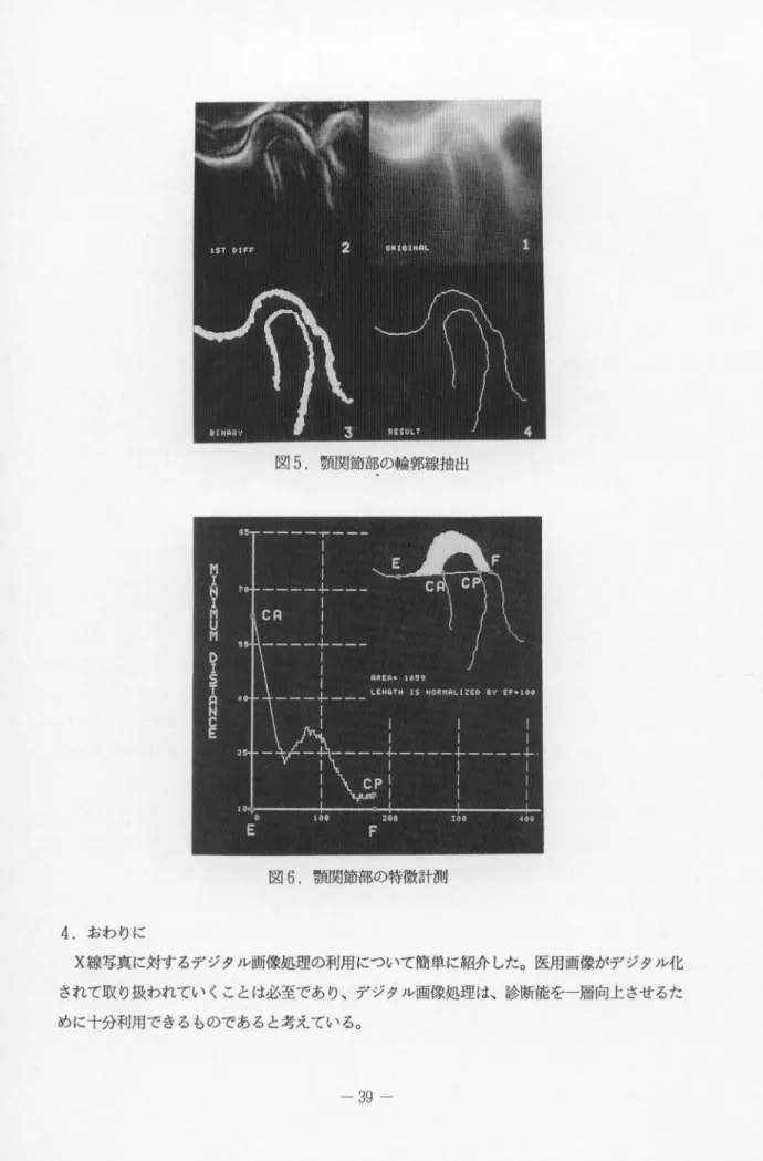 図 5 . 顎関節部の輪郭線抽出 図 6 . 顎関節部の特徴計測 4 . おわりに X 線写真に対するデジタル画像処理の利用について簡単に紹介した。医用画像がデジタル化 されて取り扱われていくことは必至であり、デジタル画像処理は、診断能を一層向上させるた めに十分利用できるものであると考えている。 n H υ  qt u  