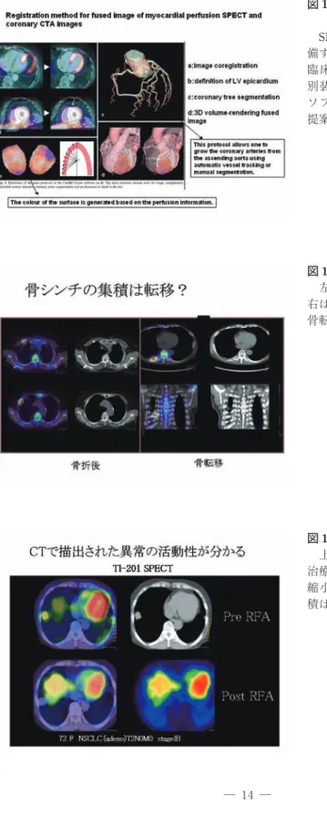 図 10 64 MSCT の冠動脈 CTA と心 筋 SPECT の融合画像 　SPECT/CT 装 置 に 64 MSCT を 装 備するのはコスト的に難しい。現在， 臨床に導入されている 64 MSCT と 別装置で撮像された心筋 SPECT を ソフトウェア法で融合させる方法が 提案されている。 図 11 骨シンチの融合画像 　左は骨折後の化骨部への集積で， 右は骨破壊部への集積である。右は， 骨転移と診断できる。 図 12  201 Tl SPECT の融合画像 　上段は，RFA 治療前，下段は R