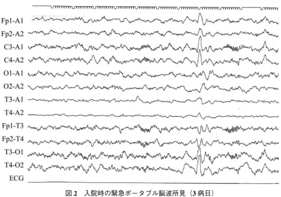図 2 入院時の緊急ポータブル脳波所見（ 3 病日） 背景波に徐波混入や左右差はなく，両側中心・頭頂部には spindle が律動的に出現し，棘 波も認められなかった． 図 3 頭部 MRI 所見（7 病日） 右側迂回槽近傍に海馬と接して髄液と等信号を呈する CFC（↓）を認めた．また，MRA に は明らかな異常はみられなかった． A，B，C：水平断，D：冠状断，E：矢状断，F：MRA６４ 京 二 赤 医 誌・Vol