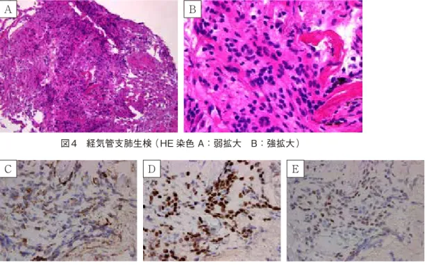 図 5　経気管支肺生検（ 免疫染色 C：vimentin　D：ER　E：PgR ）A