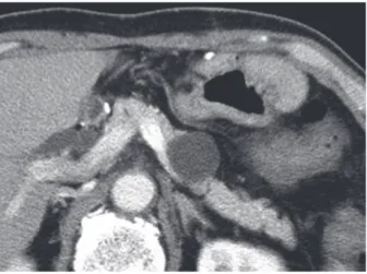図 2 　腹部単純 MRI （ T2 強調水平断） 膵体部の嚢胞性病変は被膜を有しており，また内部に 隔壁様の所見を認めた（矢印）． 図 3 　 MRCP 主膵管の拡張は認めず，主膵管と嚢胞性病変の間に明らかな交通を指摘しえなかった．図1–a　2013年施行の腹部造影CT膵体部に29mm大の嚢胞性病変を認める．図1–b　2015年施行の腹部造影CT膵体部の嚢胞径は35mmに増大していた．図1–c嚢胞壁には一部石灰化を伴っていた．