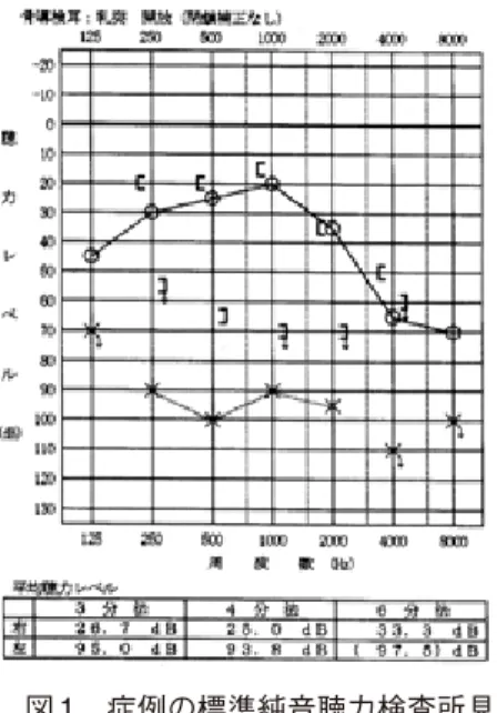 図 1　症例の標準純音聴力検査所見  左 93.8dB の感音難聴を認めた
