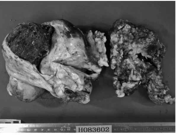 図 2 摘出標本 毛髪や脂肪成分を認める嚢胞成分と連続して，充実性腫瘤の発育を認めた． 図 3 病理組織像 角化を伴う扁平上皮癌の浸潤性増殖を認める． HE 染色×40 当院における卵巣悪性胚細胞腫瘍の臨床的検討 ５５